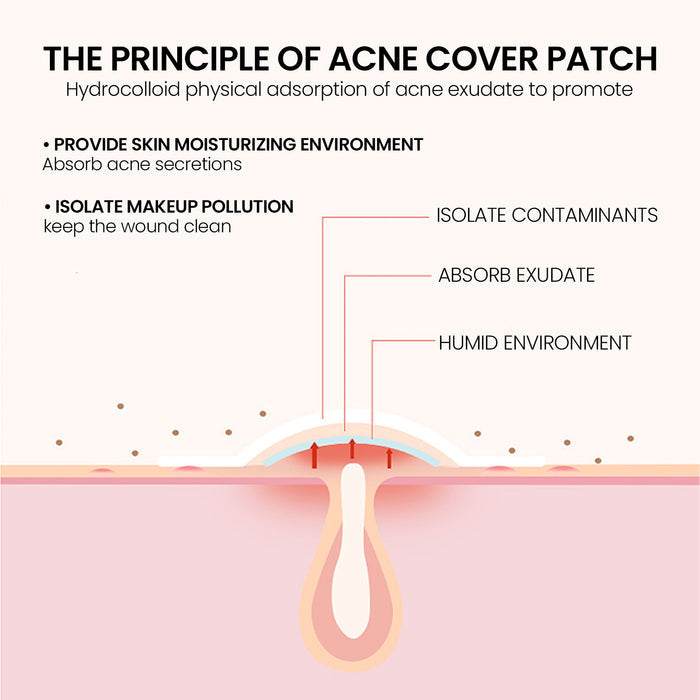 Repair Acne Patch applied on whitehead acne close-up skin detail